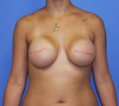 Patient 691 - Surgery 1 Photo 3 - Tissue Expander Implant - Breast Cancer Texas