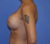 Patient 691 - Surgery 2 Photo 1 - Tissue Expander Implant - Breast Cancer Texas