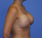 Patient 691 - Surgery 2 Photo 5 - Tissue Expander Implant - Breast Cancer Texas