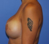 Patient 691 - Surgery 3 Photo 1 - Tissue Expander Implant - Breast Cancer Texas