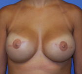 Patient 691 - Surgery 3 Photo 3 - Tissue Expander Implant - Breast Cancer Texas