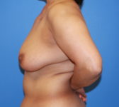 Patient 333 Before Surgey Photo 1 - Mastopexy DIEP Flap Surgery - Breast Cancer Texas