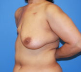 Patient 333 Before Surgey Photo 2 - Mastopexy DIEP Flap Surgery - Breast Cancer Texas