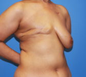 Patient 333 Before Surgey Photo 4 - Mastopexy DIEP Flap Surgery - Breast Cancer Texas