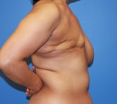Patient 333 Before Surgey Photo 5 - Mastopexy DIEP Flap Surgery - Breast Cancer Texas