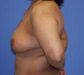 Patient 333 - Surgery 1 Photo 1 - Mastopexy DIEP Flap Surgery - Breast Cancer Texas