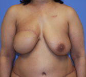 Patient 333 - Surgery 1 Photo 3 - Mastopexy DIEP Flap Surgery - Breast Cancer Texas