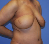 Patient 333 - Surgery 1 Photo 4 - Mastopexy DIEP Flap Surgery - Breast Cancer Texas