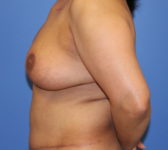 Patient 333 - Surgery 2 Photo 1 - Mastopexy DIEP Flap Surgery - Breast Cancer Texas
