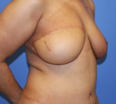 Patient 333 - Surgery 2 Photo 4 - Mastopexy DIEP Flap Surgery - Breast Cancer Texas