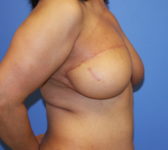 Patient 333 - Surgery 2 Photo 5 - Mastopexy DIEP Flap Surgery - Breast Cancer Texas
