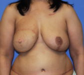 Patient 333 - Surgery 3 Photo 3 - Mastopexy DIEP Flap Surgery - Breast Cancer Texas