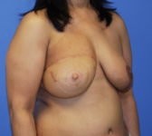 Patient 333 - Surgery 3 Photo 4 - Mastopexy DIEP Flap Surgery - Breast Cancer Texas