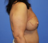 Patient 333 - Surgery 3 Photo 5 - Mastopexy DIEP Flap Surgery - Breast Cancer Texas