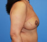 Patient 333 - Surgery 4 Photo 5 - Mastopexy DIEP Flap Surgery - Breast Cancer Texas