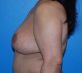 Patient 333 - Surgery 5 Photo 1 - Mastopexy DIEP Flap Surgery - Breast Cancer Texas