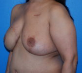 Patient 333 - Surgery 5 Photo 2 - Mastopexy DIEP Flap Surgery - Breast Cancer Texas