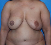 Patient 333 - Surgery 5 Photo 3 - Mastopexy DIEP Flap Surgery - Breast Cancer Texas