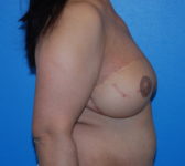 Patient 333 - Surgery 5 Photo 5 - Mastopexy DIEP Flap Surgery - Breast Cancer Texas