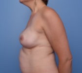 Patient 273 Before Surgey Photo 1 - Nipple Sparing Mastectomy Tissue Expander Implant - Breast Cancer Texas