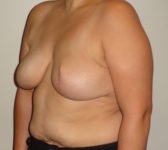Patient 276 - Surgery 1 Photo 2 - Tissue Expander Implant - Breast Cancer Texas
