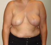 Patient 276 - Surgery 1 Photo 3 - Tissue Expander Implant - Breast Cancer Texas