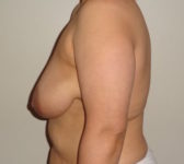 Patient 276 Before Surgey Photo 1 - Tissue Expander Implant - Breast Cancer Texas
