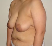 Patient 276 Before Surgey Photo 2 - Tissue Expander Implant - Breast Cancer Texas
