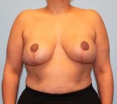 Patient 276 - 3D Tattoo Photo 3 - Tissue Expander Implant - Breast Cancer Texas