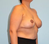 Patient 276 - 3D Tattoo Photo 4 - Tissue Expander Implant - Breast Cancer Texas