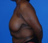 Patient 602 Before Surgey Photo 1 - Mastopexy Breast Reduction DIEP Flap Surgery - Breast Cancer Texas