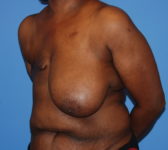 Patient 602 Before Surgey Photo 2 - Mastopexy Breast Reduction DIEP Flap Surgery - Breast Cancer Texas