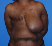 Patient 602 Before Surgey Photo 3 - Mastopexy Breast Reduction DIEP Flap Surgery - Breast Cancer Texas