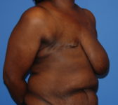 Patient 602 Before Surgey Photo 4 - Mastopexy Breast Reduction DIEP Flap Surgery - Breast Cancer Texas