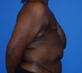 Patient 602 Before Surgey Photo 5 - Mastopexy Breast Reduction DIEP Flap Surgery - Breast Cancer Texas