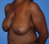 Patient 602 - Surgery 1 Photo 2 - Mastopexy Breast Reduction DIEP Flap Surgery - Breast Cancer Texas