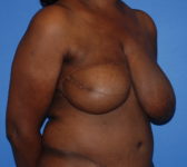 Patient 602 - Surgery 1 Photo 4 - Mastopexy Breast Reduction DIEP Flap Surgery - Breast Cancer Texas