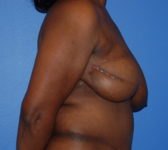 Patient 602 - Surgery 1 Photo 5 - Mastopexy Breast Reduction DIEP Flap Surgery - Breast Cancer Texas