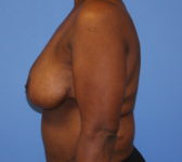 Patient 602 - Surgery 2 Photo 1 - Mastopexy Breast Reduction DIEP Flap Surgery - Breast Cancer Texas