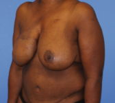 Patient 602 - Surgery 2 Photo 2 - Mastopexy Breast Reduction DIEP Flap Surgery - Breast Cancer Texas