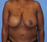 Patient 602 - Surgery 2 Photo 3 - Mastopexy Breast Reduction DIEP Flap Surgery - Breast Cancer Texas
