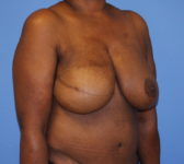 Patient 602 - Surgery 2 Photo 4 - Mastopexy Breast Reduction DIEP Flap Surgery - Breast Cancer Texas