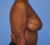 Patient 602 - Surgery 2 Photo 5 - Mastopexy Breast Reduction DIEP Flap Surgery - Breast Cancer Texas
