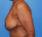 Patient 602 - Surgery 3 Photo 1 - Mastopexy Breast Reduction DIEP Flap Surgery - Breast Cancer Texas