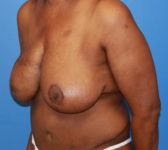 Patient 602 - Surgery 3 Photo 2 - Mastopexy Breast Reduction DIEP Flap Surgery - Breast Cancer Texas