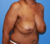 Patient 602 - Surgery 3 Photo 4 - Mastopexy Breast Reduction DIEP Flap Surgery - Breast Cancer Texas
