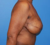 Patient 602 - Surgery 3 Photo 5 - Mastopexy Breast Reduction DIEP Flap Surgery - Breast Cancer Texas