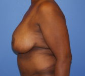 Patient 602 - Surgery 4 Photo 1 - Mastopexy Breast Reduction DIEP Flap Surgery - Breast Cancer Texas