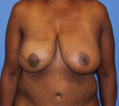 Patient 602 - Surgery 4 Photo 3 - Mastopexy Breast Reduction DIEP Flap Surgery - Breast Cancer Texas