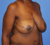 Patient 602 - Surgery 4 Photo 4 - Mastopexy Breast Reduction DIEP Flap Surgery - Breast Cancer Texas